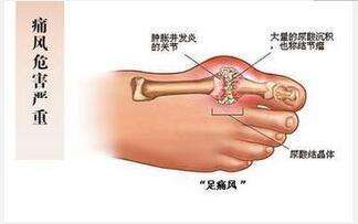 痛风有什么危害