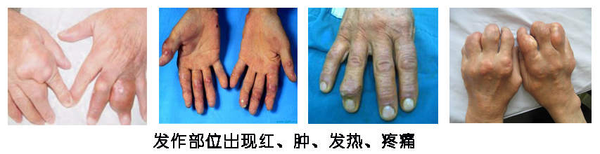 痛风是什么原因导致的