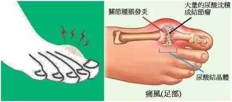 痛风的危害影响有哪些方面?