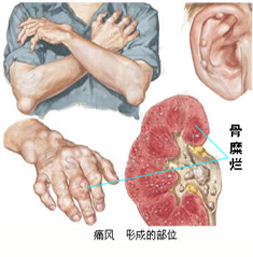 痛风患者生活中常见的误区